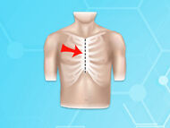 Surgeon Q&A: "Survival Rates of Minimally-Invasive Versus Sternotomy for Heart Valve Surgery?"