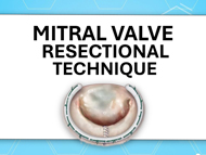 Mitral Valve Resection Techniques: What Should Patients Know?