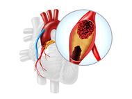 Surgeon Q&A: Coronary Artery Bypass Grafting and Heart Valve Surgery with Dr. Gianluca Torregrossa