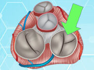 Medical Update: The Tricuspid Valve Is Not "Forgotten" Anymore