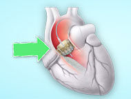 Patient Webinar: Present and Future of Heart Valve Surgery