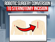 Robotic Mitral Valve Surgery: Conversion from Minimally-Invasive to Sternotomy with Dr. Kevin Hodges